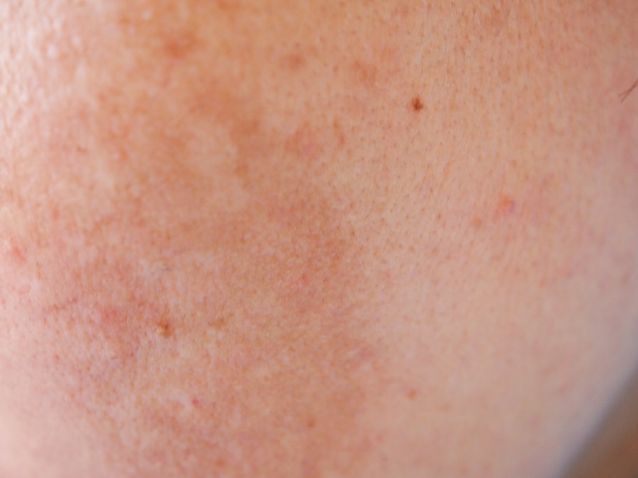 melasma grossesse 